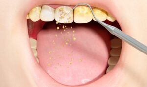 dental plaque and tartar